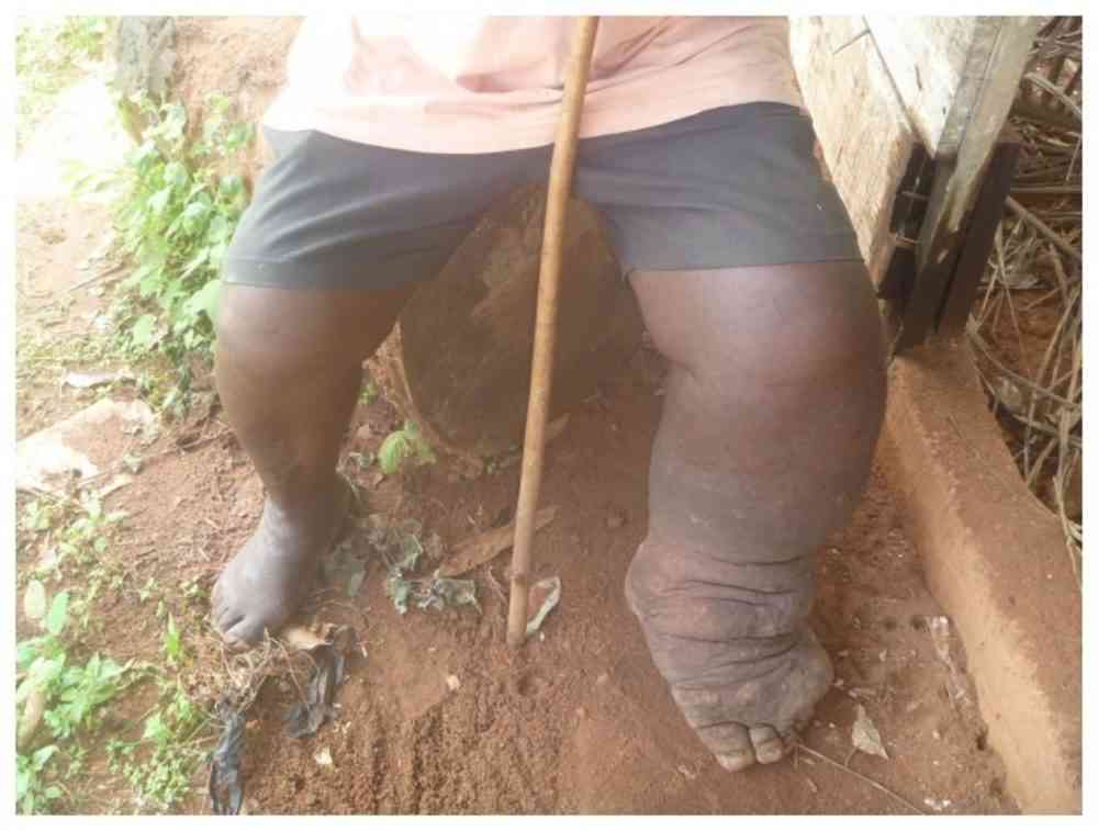 Worry as elephantiasis outbreak hits Zim