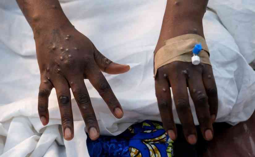 Zim records 2 Mpox cases 