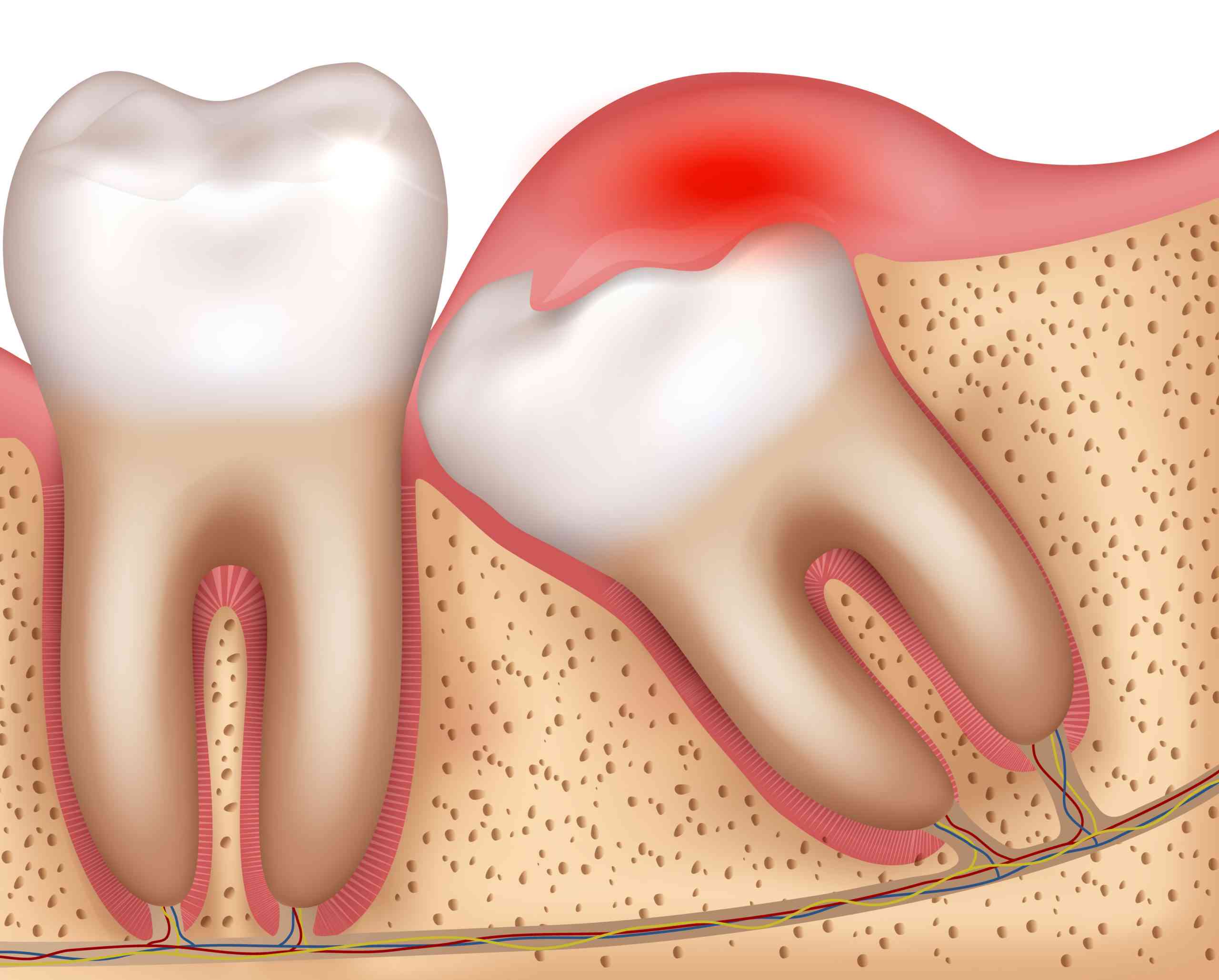 More than just a toothache: The complex reasons behind wisdom tooth pain 
