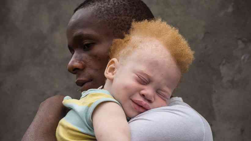 People with albinism recount stigma, myths, fear of murder for rituals