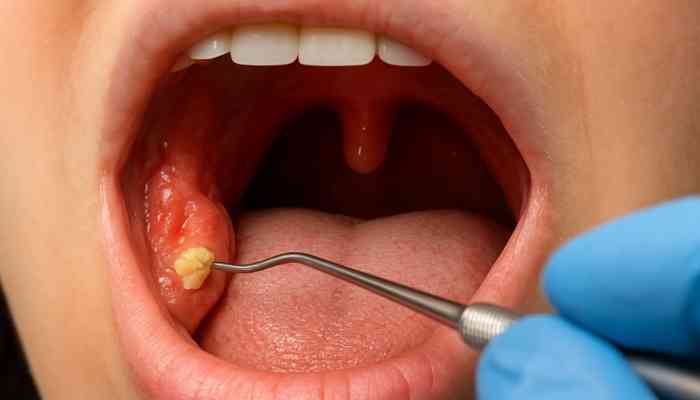 The correlation of bad breath and tonsil stones