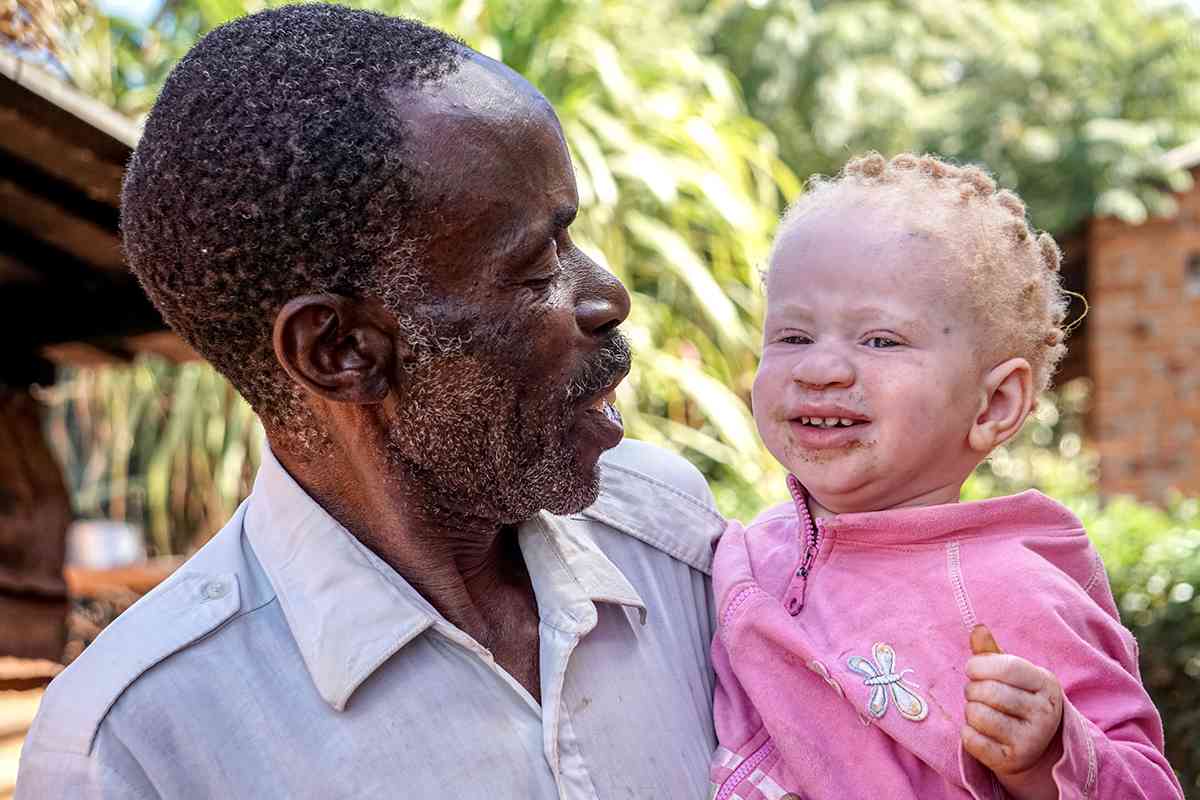 UN demands essential healthcare for Zimbabweans with albinism