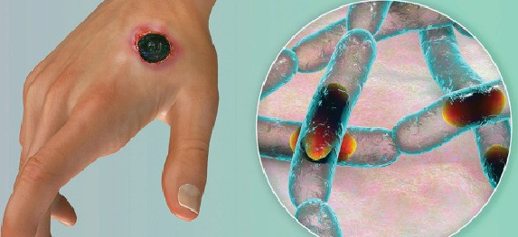 Anthrax can well be treated effectively if detected early