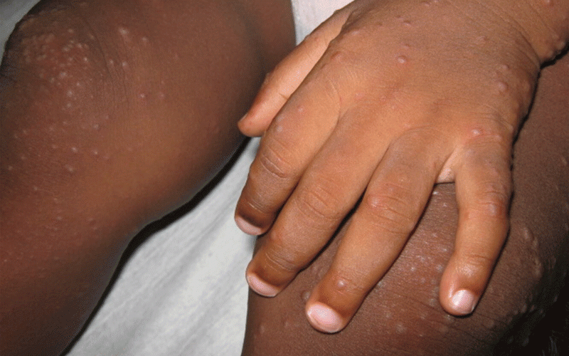 Over 600 children affected as HFMD spreads across Harare