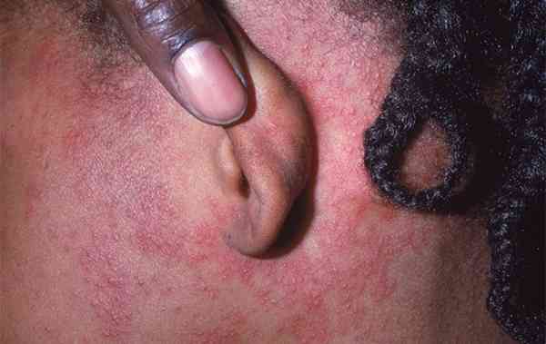 Deadly measles outbreak opens can of worms