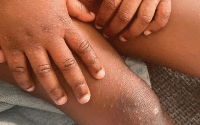 Hand, foot and mouth outbreak spreads